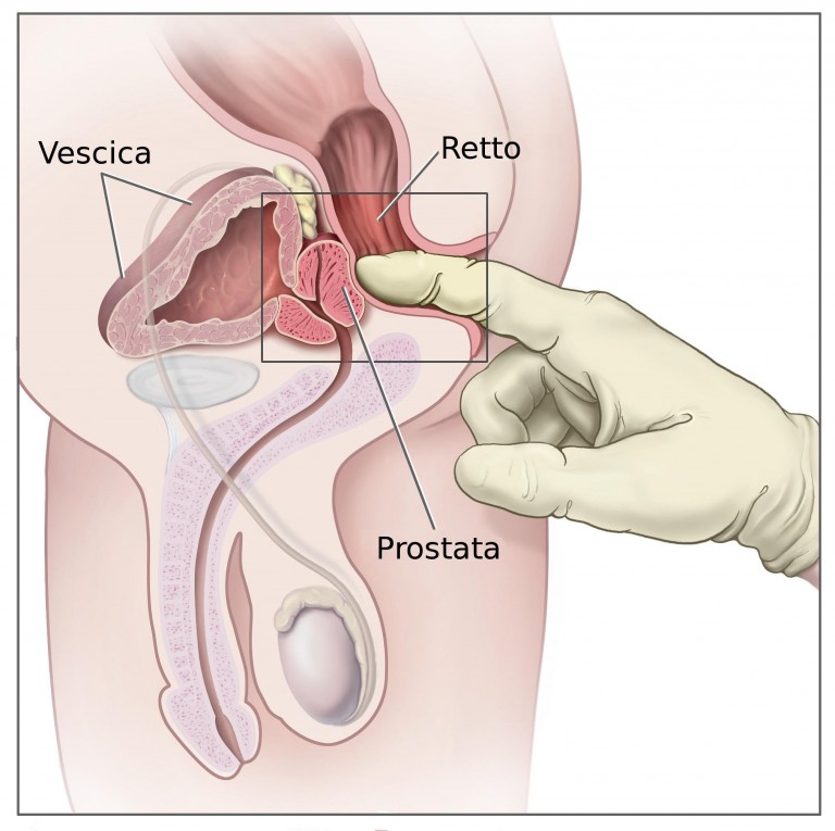 naturiste prostata semne de prostatită cum să o tratezi