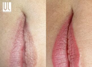 Viktoria Logoida: trattamento labbra
